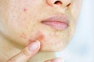 Peeling marcas de acne